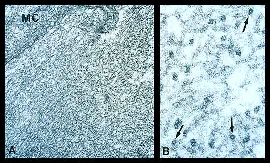 Amyloid Electron Microscopy